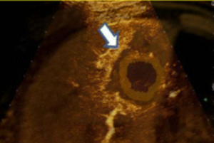 CEUS paired with US/MR fusion of the liver