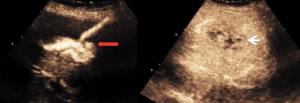 liver abscess