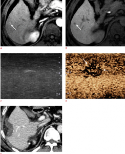 MRI Ultrasound